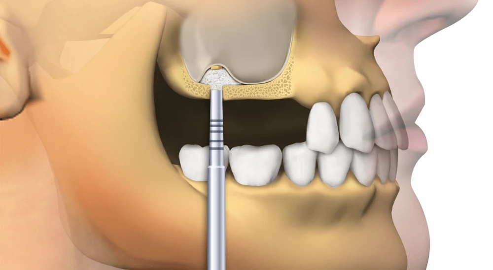 Открытый и закрытый синус-лифтинг