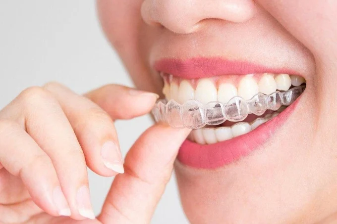 Исправление прикуса