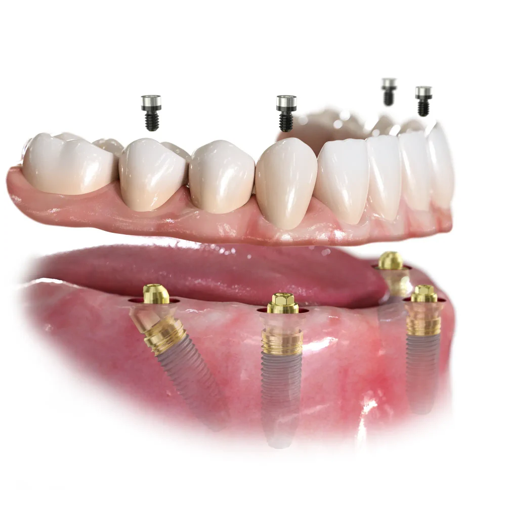 Протезирование на имплантатах