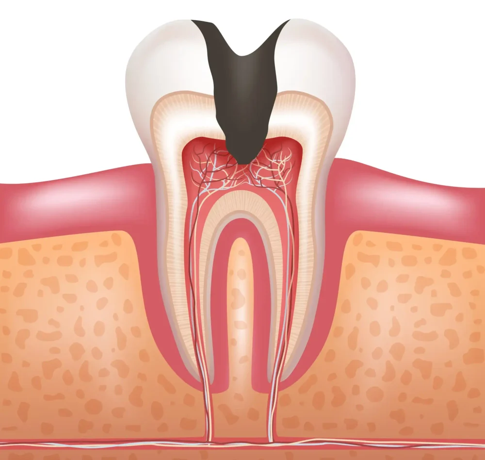 Лечение пульпита