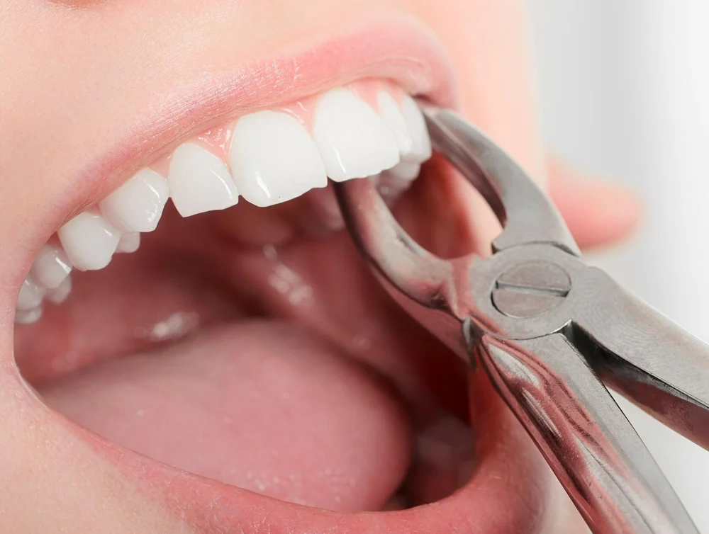 Простое удаление зуба