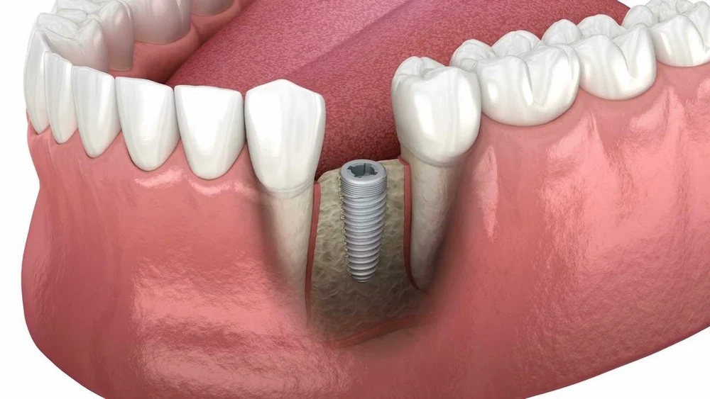 Внутрикостная имплантация