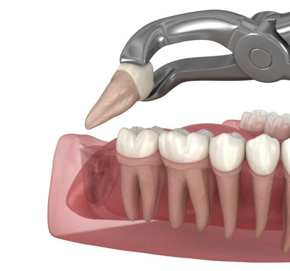 Удаление зубов мудрости